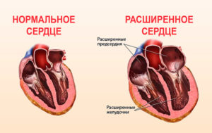 Большое сердце болезнь лечение. Диагноз большое сердце что это такое. Причины роста размеров сердца