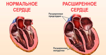 Большое сердце болезнь лечение. Диагноз большое сердце что это такое. Причины роста размеров сердца