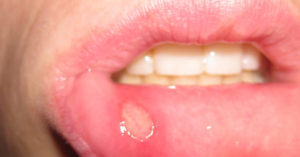 Гнойник во рту на губе. Что делать, если появилась болячка на губе? Что это может быть