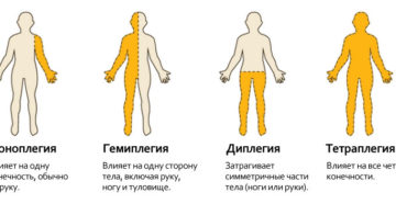 Что такое правосторонний гемипарез? Причины появления у детей и взрослых. Что такое гемипарез и гемиплегия