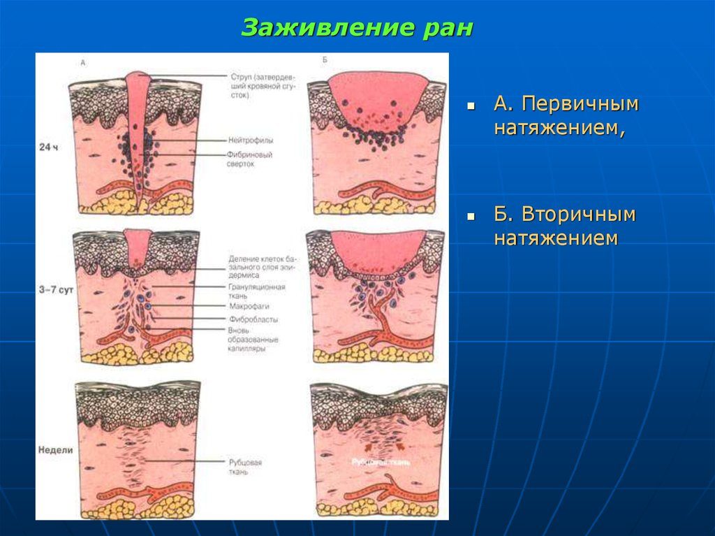 Грануляция тканей после операции. Грануляция – один из процессов заживления раны. Как выглядит грануляционная ткань