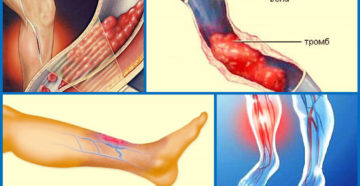 Что такое флеботромбоз и чем он опасен? Флеботромбоз — что это, какие симптомы у каждого вида патологии