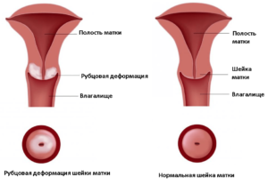 Рубцовая деформация шейки матки: причины и лечение. Шейка матки после родов