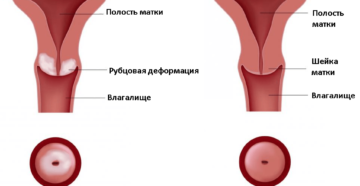 Рубцовая деформация шейки матки: причины и лечение. Шейка матки после родов