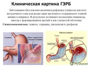 Симптомы и лечение гастроэзофагеальной рефлюксной болезни. Заброс желудочной кислоты в пищевод: причины, диагностика, лечение