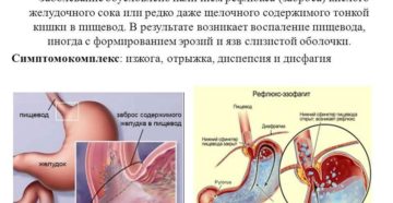 Симптомы и лечение гастроэзофагеальной рефлюксной болезни. Заброс желудочной кислоты в пищевод: причины, диагностика, лечение