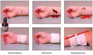 Больно ли умирать от вскрытия вен. Алгоритм оказания первой помощи при порезе вены на руке. Когда нужен врач