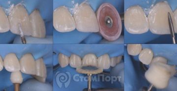 Замена воска на пластмассу, обработка и полировка. Техника изготовления пластмассовых коронок и мостовидных протезов