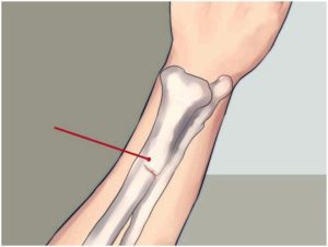 Диагностика и лечение трещины в руке. Как долго заживает трещина в кости