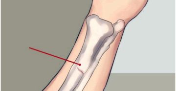 Диагностика и лечение трещины в руке. Как долго заживает трещина в кости