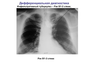 Всегда ли рак легкого от туберкулеза. Как отличить туберкулез от рака легких