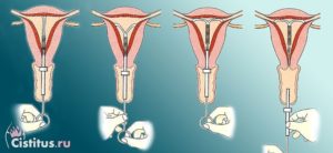 Беременность после спирали совет гинеколога. Можно ли забеременеть после удаления спирали, советы гинеколога