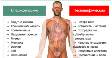 Рак легких в термальной стадии: причины развития и основные симптомы. Терминальная стадия онкологических заболеваний