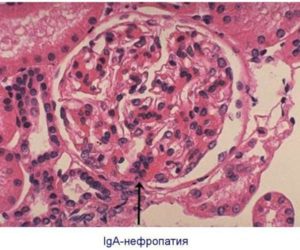 IgA нефропатия или болезнь Берже. IgA-нефропатия