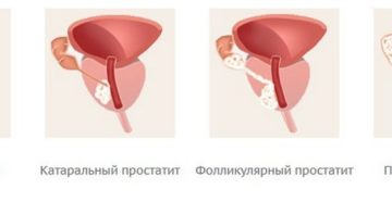 Хронический паренхиматозный простатит. Острый простатит. Острое фолликулярное воспаление простаты