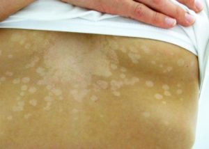Солнечный грибок на коже: причины, симптомы и лечение. Солнечный грибок