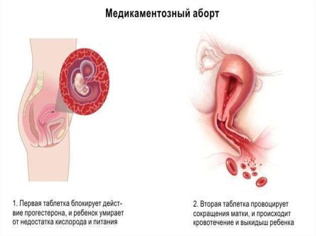 Слизь с кровью после медикаментозного прерывания беременности. Сколько идет кровь после медикаментозного прерывания беременности