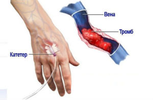 Как лечить вены после катетера. Клинические признаки и способы борьбы с флебитом