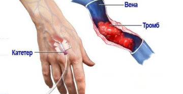 Как лечить вены после катетера. Клинические признаки и способы борьбы с флебитом