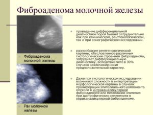 Фибромиома молочной железы лечение. Фибромиома молочной железы: причины развития, симптомы и лечение патологии. Как диагностируется доброкачественная опухоль молочной железы