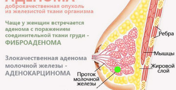 Аденома молочной железы: причины появления, симптомы и лечение патологии. Аденома соска молочной железы