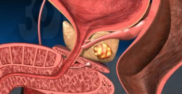 Сколько живут с саркомой простаты. Как лечить саркому простаты. Питание при саркоме