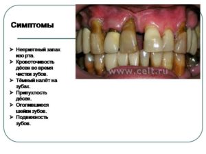 Кровоточивость десен и запах изо рта. Что делать, если кровоточат десна и неприятный запах изо рта даже после чистки зубов: причины и лечение. Почему кровоточат десна