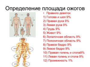 Ожоги: площадь ожогов, определение по правилу ладони. Классификация ожогов по площади и степени поражения. Методы определения площади ожога