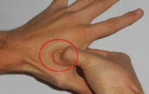 Отек между большим и указательным пальцем. Какие болевые точки есть на руке. Опухоли между пальцев руки и на фалангах