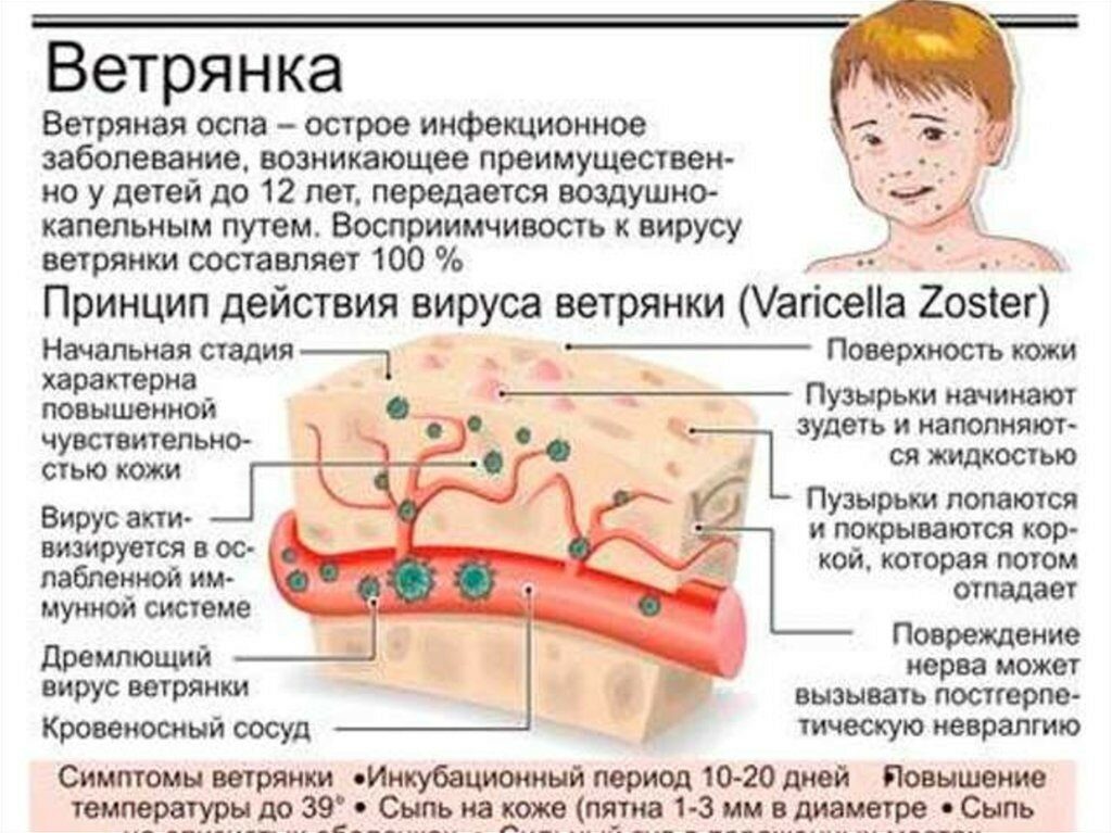 Могут ли груднички заболеть ветрянкой. Что говорит доктор Комаровский. Особенности проявления болезни