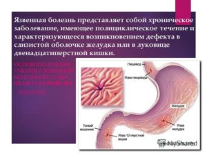 Что такое пролапс желудка. Симптомы и лечение пролапса слизистой желудка в пищевод. Признаки ГЭР, являющегося патологией