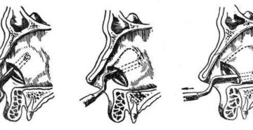 Что такое резекция носовой перегородки. Подслизистая резекция носовой перегородки. Резекция сигмовидной кишки - причины, показания, прогноз и последствия