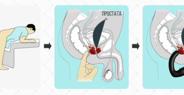 Какой Купить Массажер Простаты