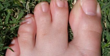 Сросшиеся указательный и средний пальцы на ногах. Синдактилия пальцев. Когда происходит операция