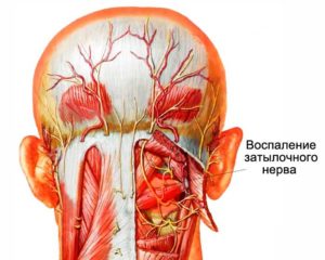 Воспаление нервных окончаний на спине. Затылочный нерв, воспаление: симптомы и лечение