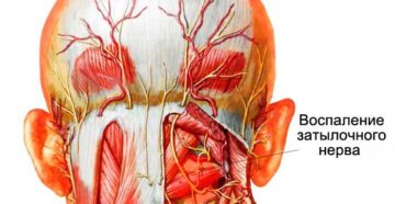Воспаление нервных окончаний на спине. Затылочный нерв, воспаление: симптомы и лечение