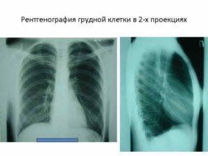 Флюорография грудной клетки в 2 х проекциях. Для чего делают рентген легких. Показывает ли рентген рак легких