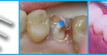 На какой зуб можно поставить штифт. В каких случаях ставят штифт в зуб: что это такое, достоинства и недостатки, виды изделий. Перспективно ли наращивание на штифт