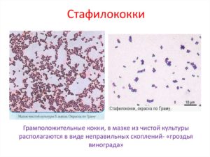 Лечение стафилококковой стрептококковой инфекции матки. Золотистый стафилококк у женщин в мазке