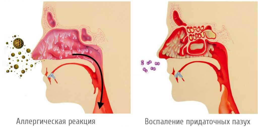 Постоянные выделения из носа по задней стенке. Диагностика слизи в горле: когда стоит обратиться к врачу? Причины стекания слизи по задней стенке горла