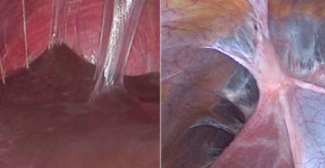 Как появляются спайки после операции. Могут ли образоваться спайки после лапароскопии