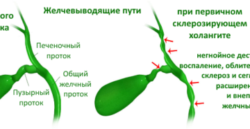 Забиты желчные протоки. Лечение обструкции желчных путей. Патогенез закупорки желчных путей