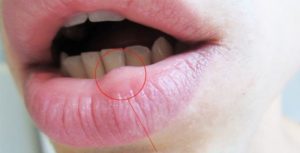 Появилась шишка на верхней губе. Почему вылезла шишка на губе – природа симптоматики и методы терапии. Рак губы симптомы, рак нижней и верхней губы