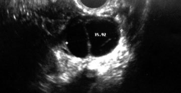 Жидкостное образование правого яичника. Кистозное образование правого яичника