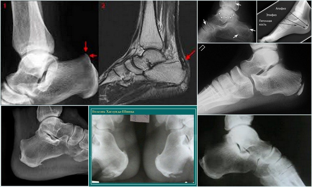 Клиническая картина остеохондропатии пяточной кости и ее лечение. Остеохондропатия пяточной кости: симптомы и лечение
