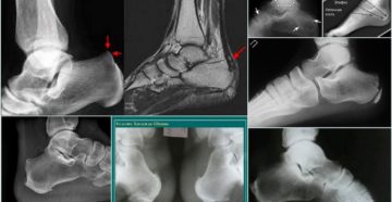 Клиническая картина остеохондропатии пяточной кости и ее лечение. Остеохондропатия пяточной кости: симптомы и лечение