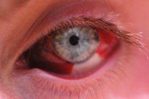 Что означает кровь на глазе. Что делать, если глаз залило кровью? Причины и методы лечения