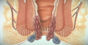 Почему чешется сфинктер. Причины зуда в заднем проходе
