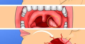 Болит миндалина с одной стороны: опухла гланда и воспалилось горло