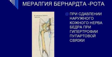 Или парестетическая мералгия рота